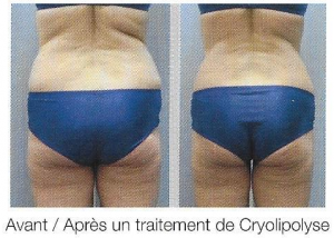 cryo06