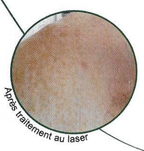 Après traitement au laser