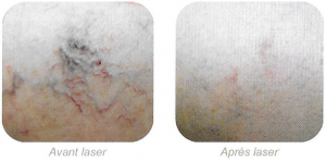 avant_apres_laser