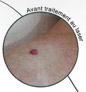 Avant traitement au laser